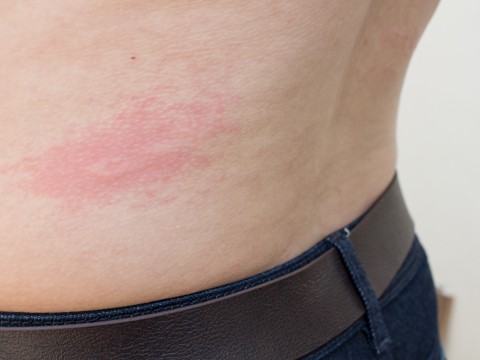 a woman is urticaria on back