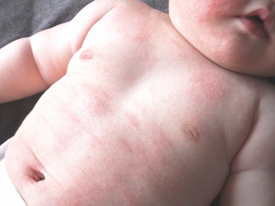 赤ちゃんでも発症するアレルギー。原因を突き止めて適切な治療を